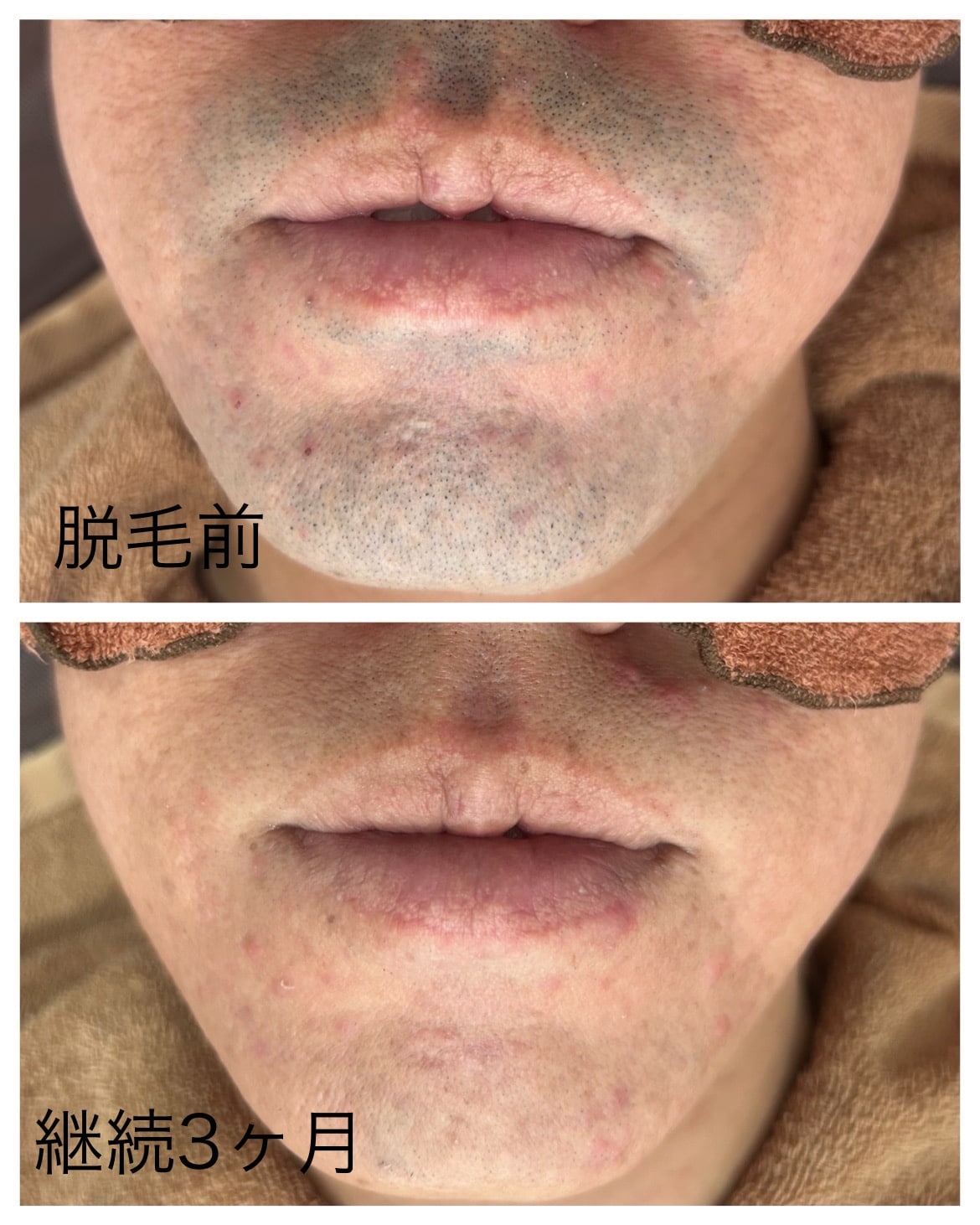 ヒゲ脱毛継続して3ヶ月経過〜 - AKALA（読谷店）